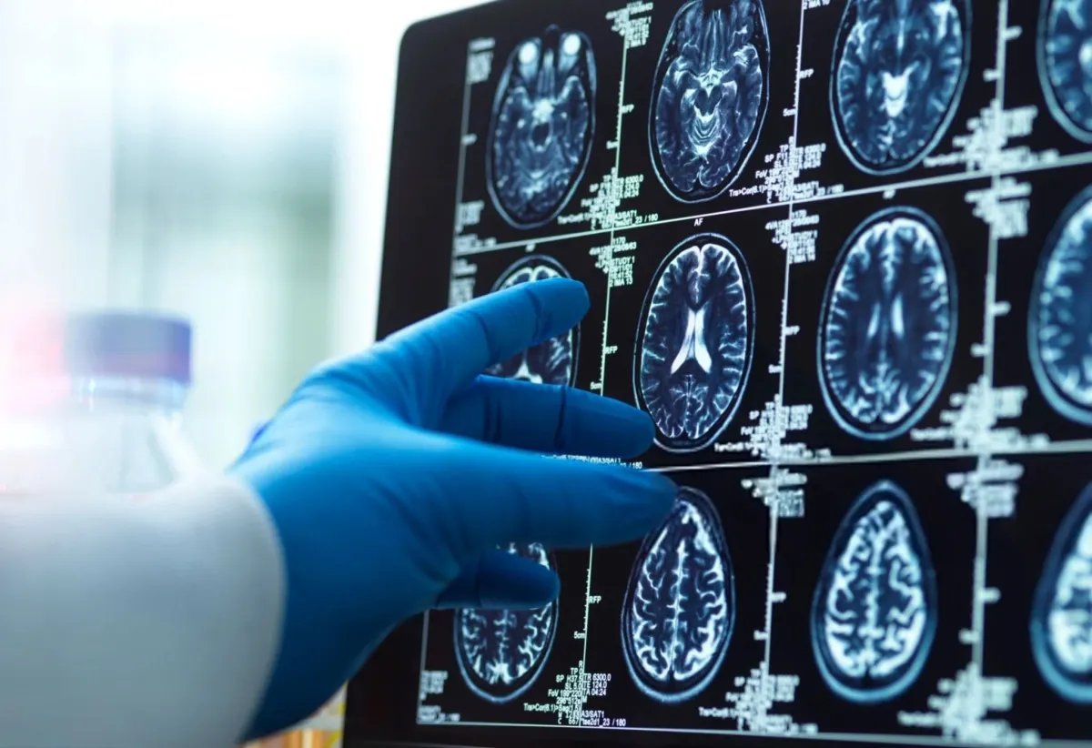 What Scientists Learned From S.M.'s Brain