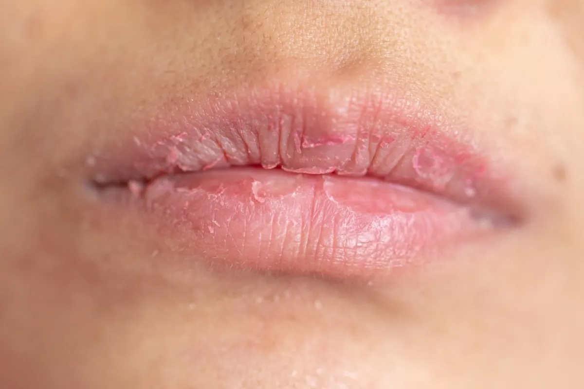 14 Common Causes of Dry Lips and How to Treat Them