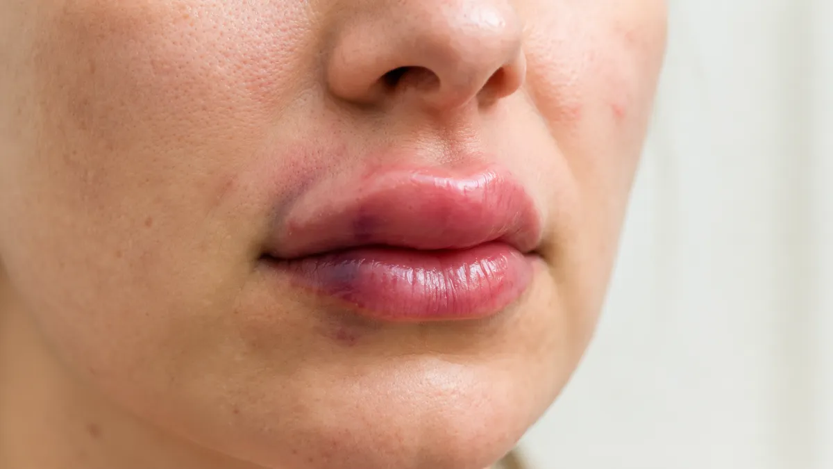Lip Swelling