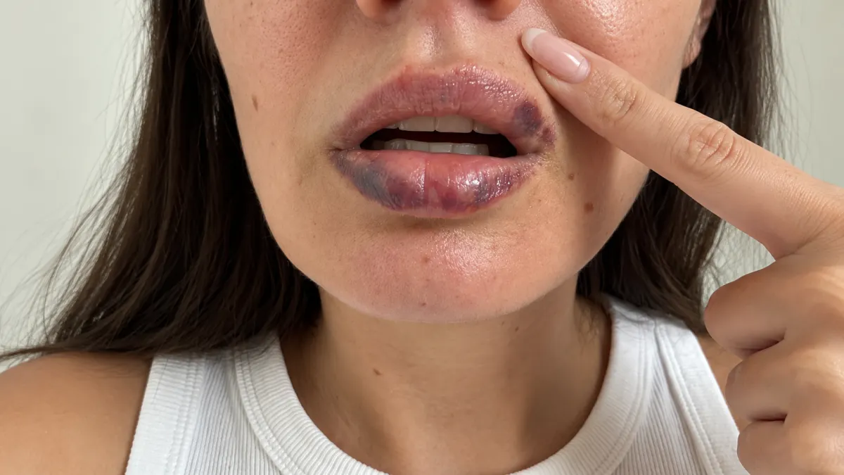 Bruising  lips