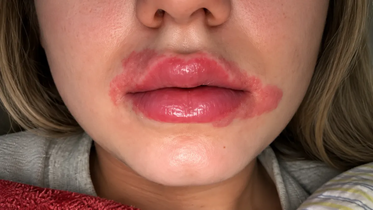 Redness and Itching