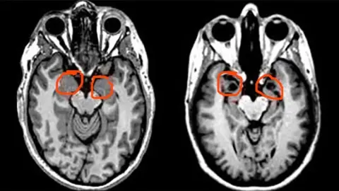 The Woman Who Couldn’t Feel Fear: The Rare Brain Condition That Changed Neuroscience