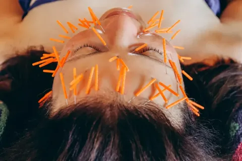 The Natural Botox? How Facial Acupuncture is Rewiring the Anti-Aging Scene