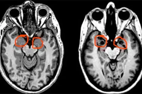 The Woman Who Couldn’t Feel Fear: The Rare Brain Condition That Changed Neuroscience
