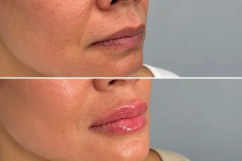 Lip Filler Side Effects: 10 Temporary and Serious Risks to Know