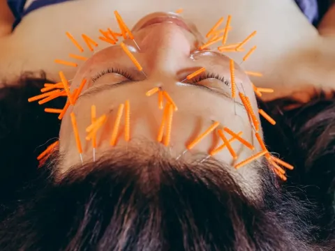 The Natural Botox? How Facial Acupuncture is Rewiring the Anti-Aging Scene