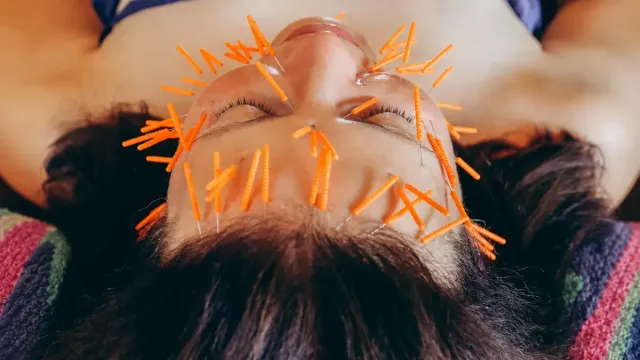 The Natural Botox? How Facial Acupuncture is Rewiring the Anti-Aging Scene