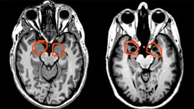 The Woman Who Couldn’t Feel Fear: The Rare Brain Condition That Changed Neuroscience