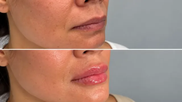 Lip Filler Side Effects: 10 Temporary and Serious Risks to Know